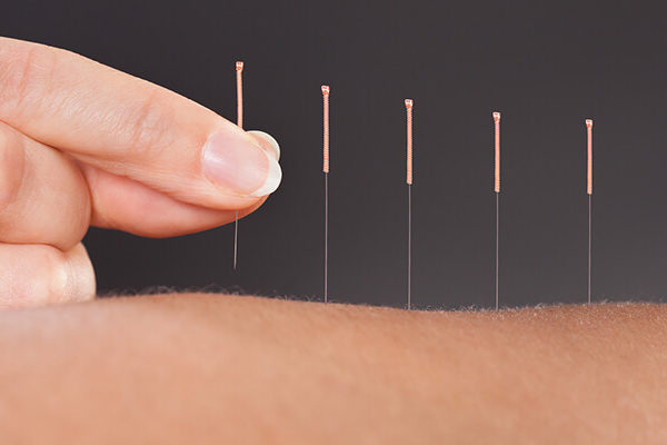 Acupuncture in West Orange, NJ